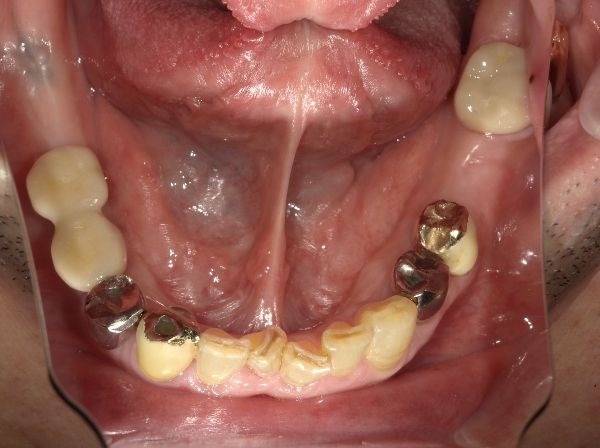 インプラント | あさの歯科 | 名古屋市南区の歯医者さん