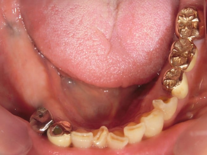 インプラント | あさの歯科 | 名古屋市南区の歯医者さん